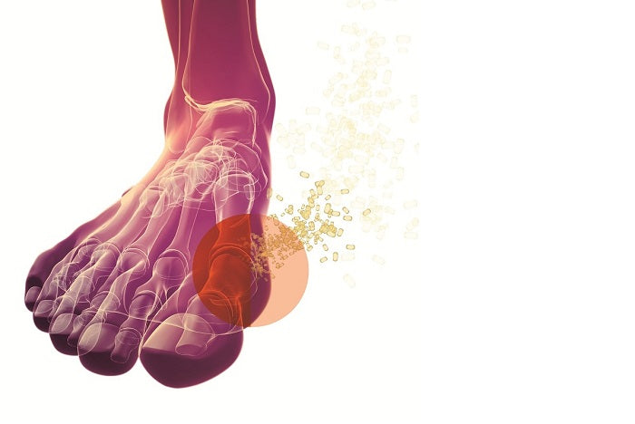 Routed by Gout