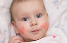 Tips For Soothing Eczema In Babies And Young Children